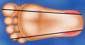 capillary blood glucose in newborn