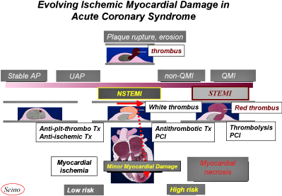 Cardiac Biomarkers For Acute Coronary Syndrome And Ongoing Myocardial ...