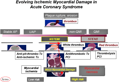 FIGURE I: Evolving Ischemic Myocardial Damage in ACS