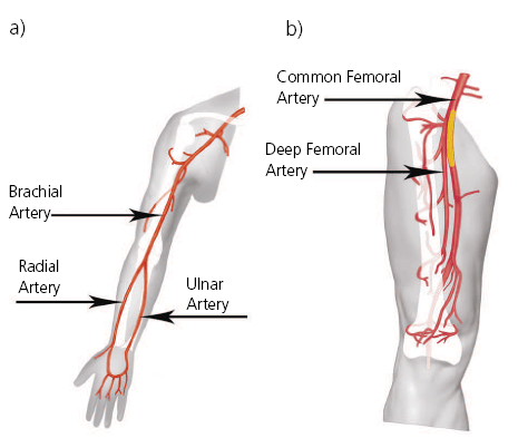 arterial blood spray